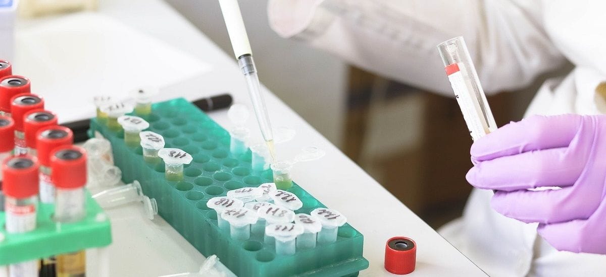 Υδροκορτιζόνη μειώνει τη θνητότητα των ασθενών με βαριές μορφές κορονοϊού
